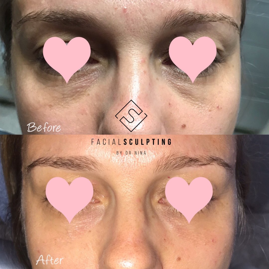 DrNinaBal's tweet photo. Wipe away 10 even 15 years from your face in just 30 minutes. Is it magic? No, it's one of the "WOW treatments" that almost instantly changes your face and overall appearance. 
Find out everything about this procedure on my latest IG post! https://t.co/K7690AuCpI