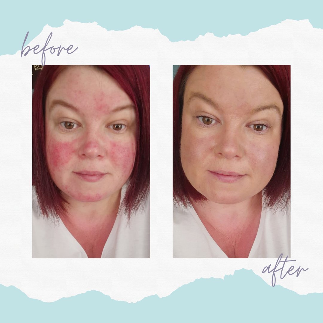 Rosalique Skincare on Twitter: "We wanted to these amazing results a customer using only Rosalique.⁠ ⁠ Buy your Rosalique today! https://t.co/W2LkWgZuCC #Rosalique #rosacea #acne #redness #antiredness #blemishes #spiderveins #flushedskin ...