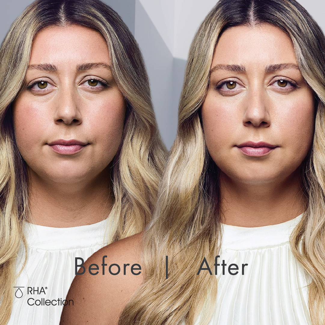 UltimateImageCo's tweet photo. The RHA® Collection was designed to adapt to the most dynamic areas of the face. 😍

#RHACollection #DesignerFiller #RHAHoliday #DesignerFillers #TampaFL #ClearwaterFL #AestheticTreatments https://t.co/EAbBG8Fp25
