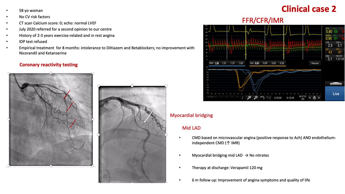 Sici GISE (@sicigise) on Twitter photo A tailored therapy guided by physiology can improve symptoms and quality of life of women with different INOCA types <a href="/alaide_chief/">chief</a> <a href="/espogiov/">Giovanni Esposito</a> <a href="/G_Tarantini01/">Giuseppe_Tarantini</a> <a href="/WomenAs1/">Women As One</a> <a href="/d_trabattoni/">Daniela Trabattoni</a> <a href="/valeriaparadies/">Valeria Paradies</a> <a href="/giuliamasiero3/">giulia masiero</a> <a href="/EAPCI/">EAP Cayman</a> <a href="/franzone_anna/">Anna Franzone</a> <a href="/FedericaSerino/">federica serino</a> A tailored therapy guided by physiology can improve symptoms and quality of life of women with different INOCA types <a href="/alaide_chief/">chief</a> <a href="/espogiov/">Giovanni Esposito</a> <a href="/G_Tarantini01/">Giuseppe_Tarantini</a> <a href="/WomenAs1/">Women As One</a> <a href="/d_trabattoni/">Daniela Trabattoni</a> <a href="/valeriaparadies/">Valeria Paradies</a> <a href="/giuliamasiero3/">giulia masiero</a> <a href="/EAPCI/">EAP Cayman</a> <a href="/franzone_anna/">Anna Franzone</a> <a href="/FedericaSerino/">federica serino</a>