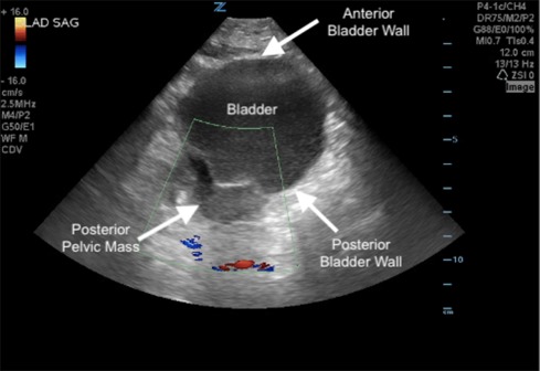 Editors@VJEM (@editorsvjem) on Twitter photo Come find out what our authors at <a href="/ColumbiaEM/">Columbia Emergency Medicine</a> and <a href="/ColumbiaEMSono/">ColumbiaEMSono</a> diagnose with #ultrasound! Check the link below! #POCUS for the win! #medtwitter #EMbound #visualdiagnosis <a href="/LauraChenevert/">Laura Chenevert</a> <a href="/nathanvtodd/">Nathan Todd</a> <a href="/JTDocintheMakin/">Jimmy Truong, DO</a> <a href="/bernardchangMD/">Bernard P. Chang MD PhD</a> <a href="/AngelaMMills/">Angela Mills MD</a> doi.org/10.1016/j.visj… Come find out what our authors at <a href="/ColumbiaEM/">Columbia Emergency Medicine</a> and <a href="/ColumbiaEMSono/">ColumbiaEMSono</a> diagnose with #ultrasound! Check the link below! #POCUS for the win! #medtwitter #EMbound #visualdiagnosis <a href="/LauraChenevert/">Laura Chenevert</a> <a href="/nathanvtodd/">Nathan Todd</a> <a href="/JTDocintheMakin/">Jimmy Truong, DO</a> <a href="/bernardchangMD/">Bernard P. Chang MD PhD</a> <a href="/AngelaMMills/">Angela Mills MD</a> doi.org/10.1016/j.visj…