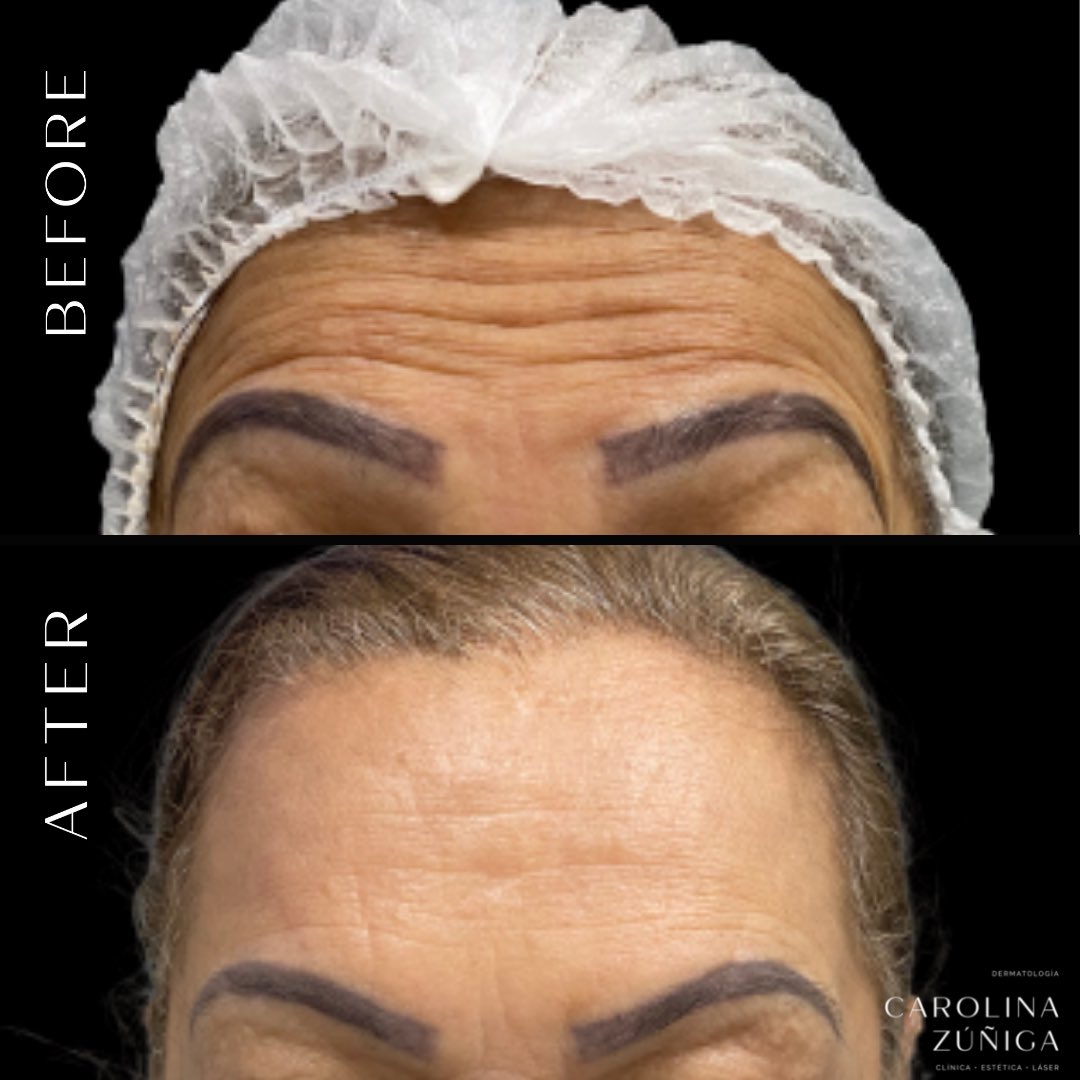 carozunigaderma's tweet photo. Algunos lindos resultados con toxina botulínica (Botox) 🤍👏🏻🥰 https://t.co/ErvTSVwnXk