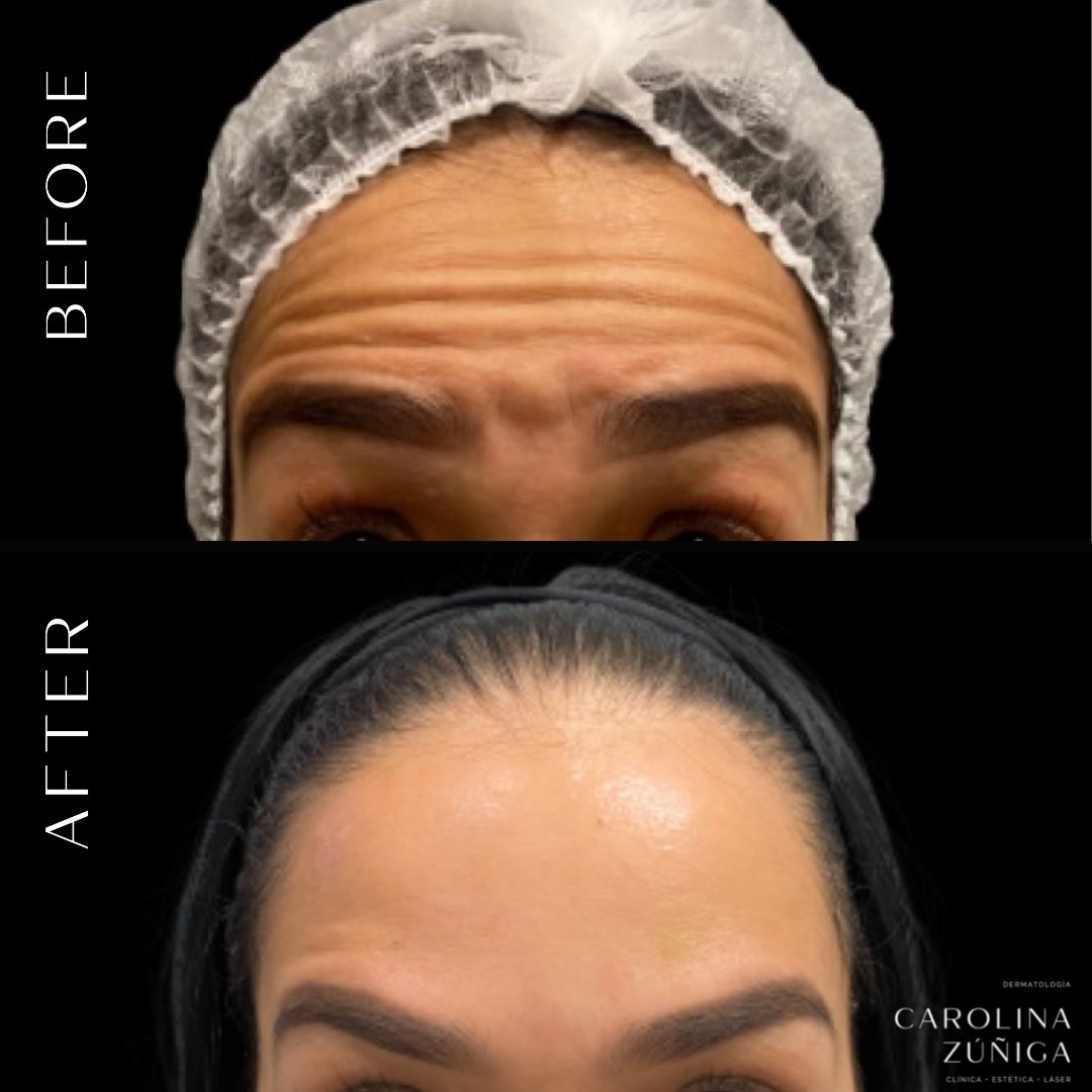 carozunigaderma's tweet photo. Algunos lindos resultados con toxina botulínica (Botox) 🤍👏🏻🥰 https://t.co/ErvTSVwnXk