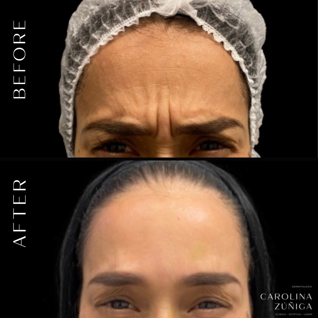 carozunigaderma's tweet photo. Algunos lindos resultados con toxina botulínica (Botox) 🤍👏🏻🥰 https://t.co/ErvTSVwnXk