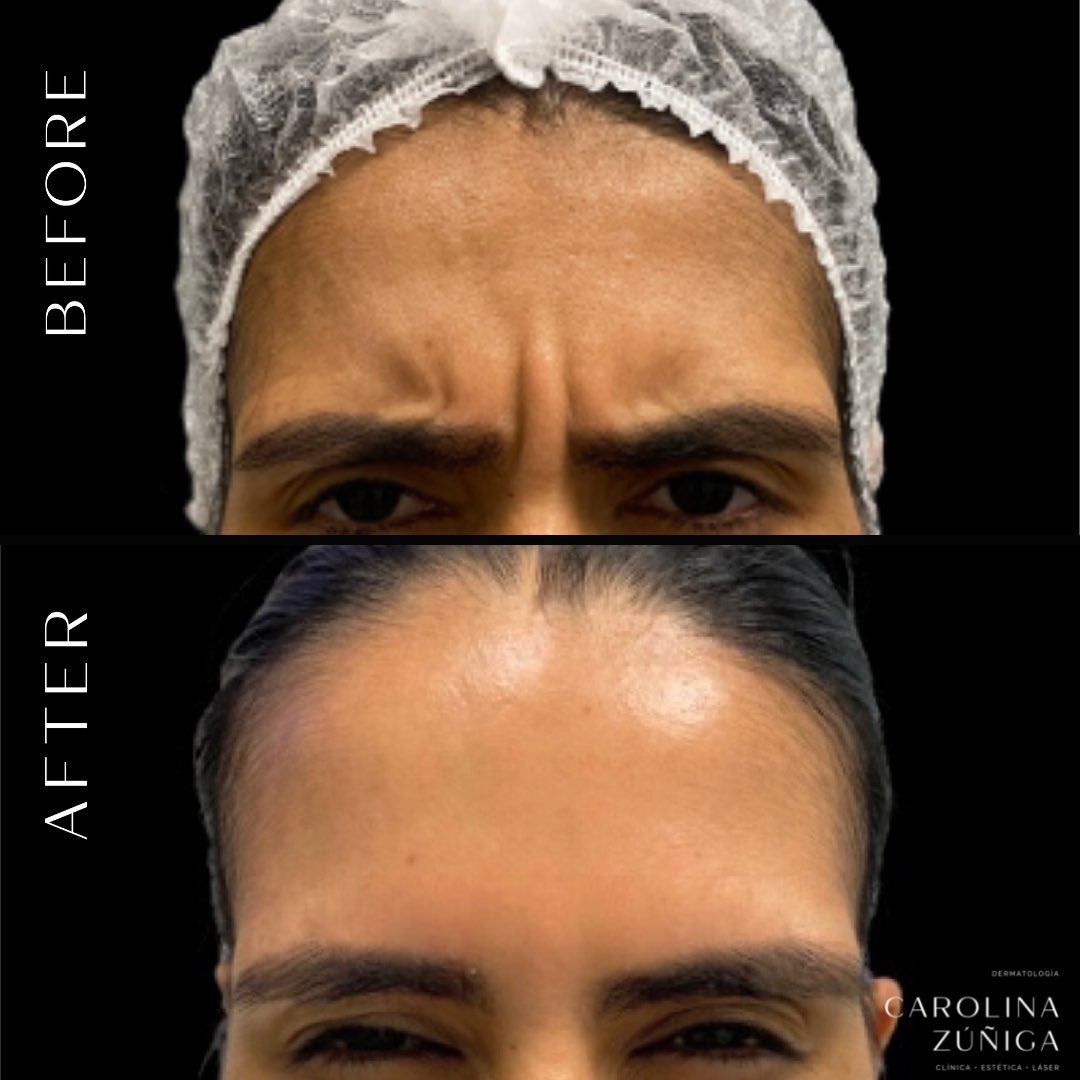 carozunigaderma's tweet photo. Algunos lindos resultados con toxina botulínica (Botox) 🤍👏🏻🥰 https://t.co/ErvTSVwnXk