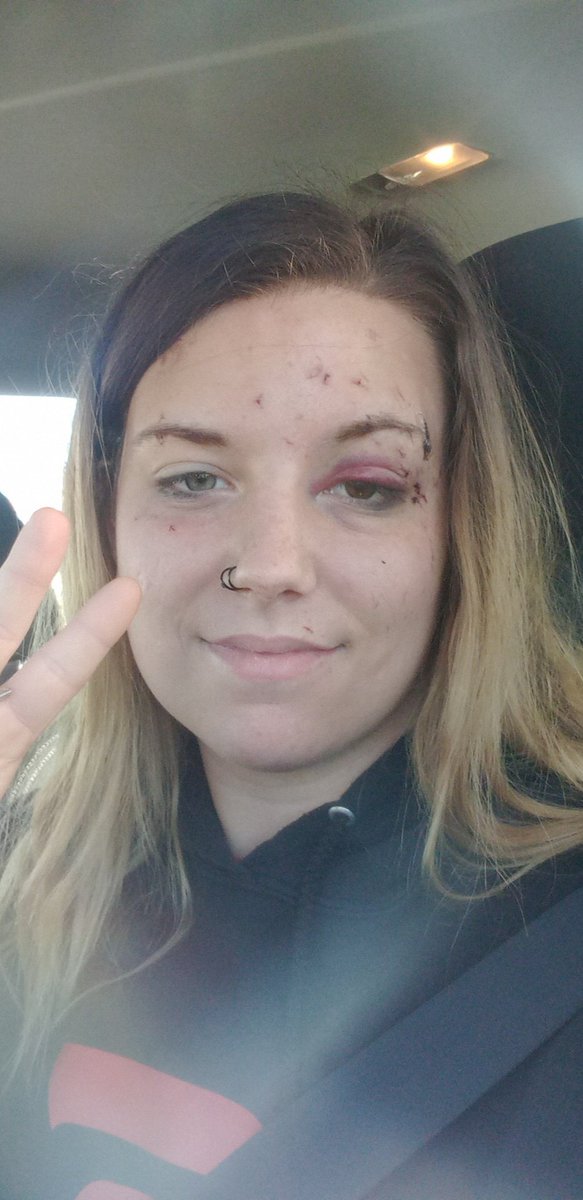 PerryRaegan's tweet image. Didnt die from drugs didnt die from a wreck. 16 staples to the head and i am lucky to be alive.