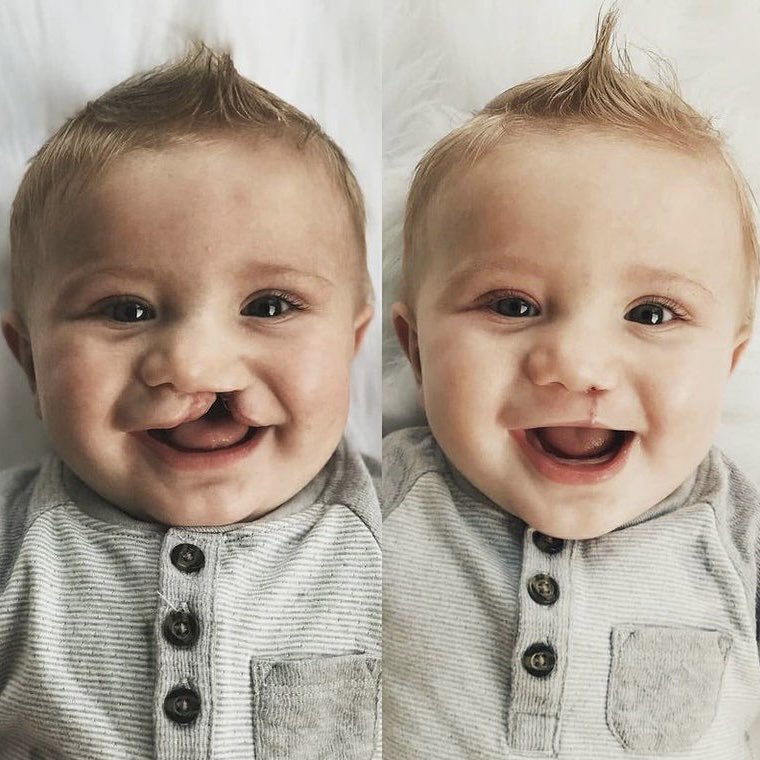 HowardFarran's tweet photo. Cleft lip and cleft palate. Two weeks after surgery. https://t.co/Zu1Yytirbr