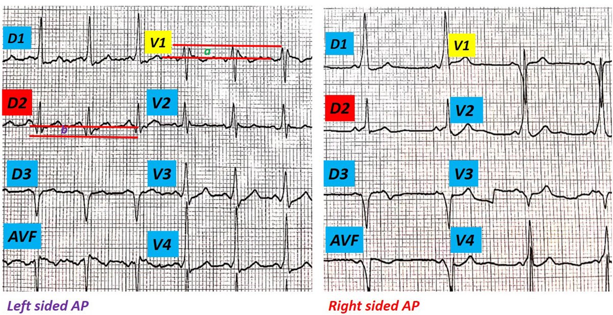 The predictive value of the V1r + DIIq criterion for differentiating right- from left-sided paraseptal accessory pathways #NewOnline sciencedirect.com/science/articl…