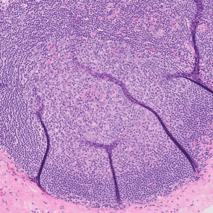 NathanPaulsonMD's tweet photo. LN game time: which follicle(s) is/are neoplastic, if any? #hemepath #pathology https://t.co/vZz8XSaFVp