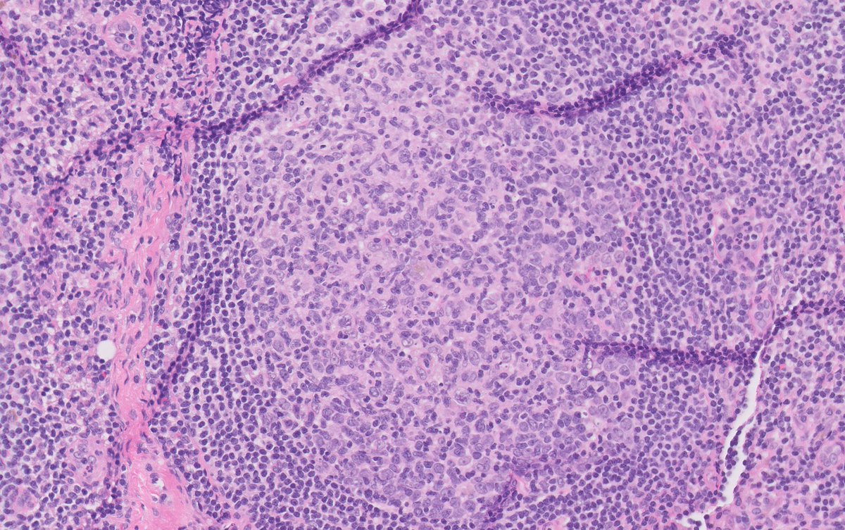 NathanPaulsonMD's tweet photo. LN game time: which follicle(s) is/are neoplastic, if any? #hemepath #pathology https://t.co/vZz8XSaFVp