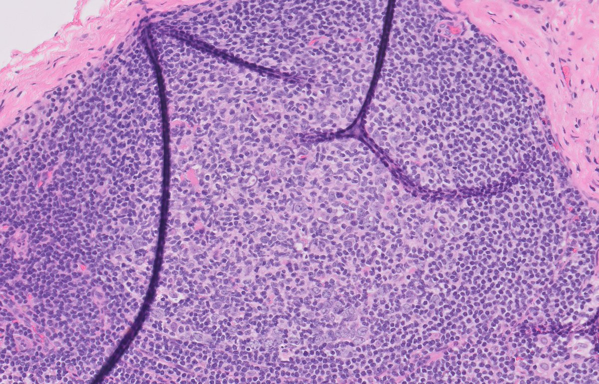 NathanPaulsonMD's tweet photo. LN game time: which follicle(s) is/are neoplastic, if any? #hemepath #pathology https://t.co/vZz8XSaFVp