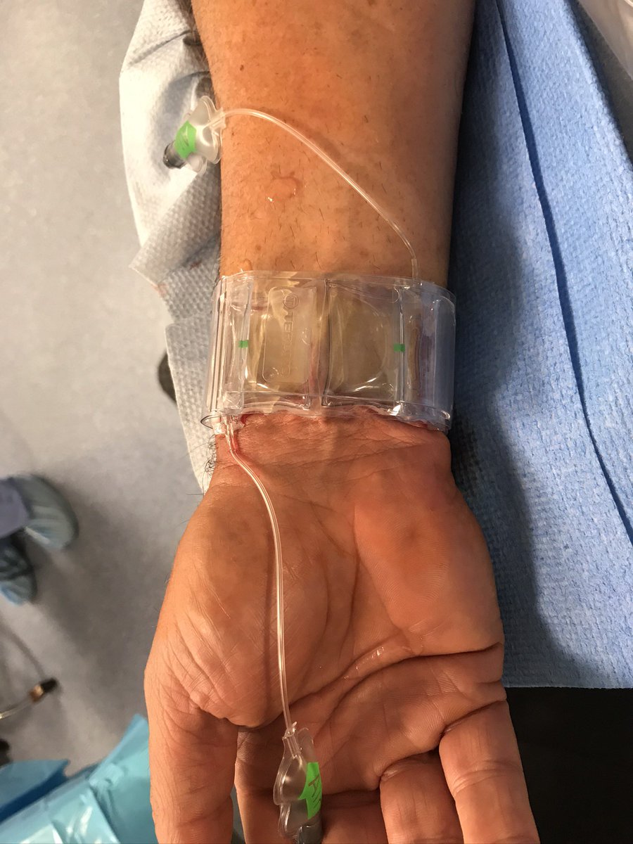 KaulP's tweet photo. @Updock My default approach if there is a #RadialFirst loop is US guided ipsilateral #UlnarSecond. Typically happens maybe 2-4 x per year for me. I use a single hemostasis band with a second balloon cut from another band and placed under the first. See also: https://t.co/SxgVEc7Dsz https://t.co/8LIxahIsXG