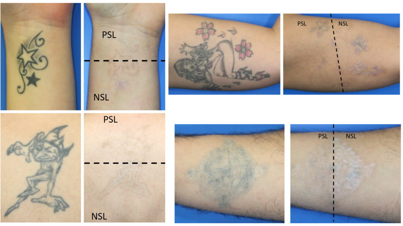 Tattoo removal in bangalore  Laser treatment for tattoo removal   surgiderma