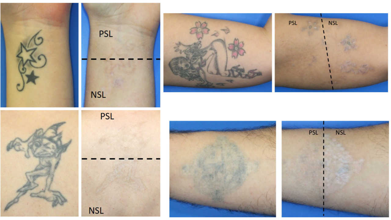 Tattoo removal in bangalore Laser treatment for tattoo removal surgiderma
