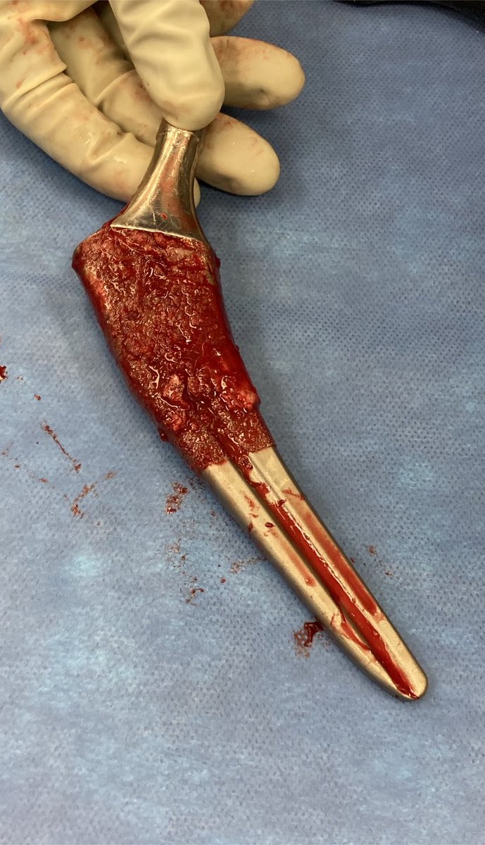 6 minutes!!  Another great outcome for the patient.  #orthotwitter #noeto