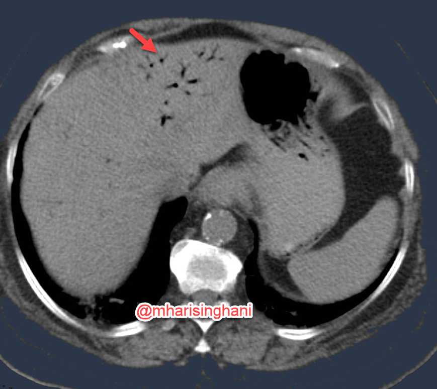 mharisinghani's tweet photo. peripheral branching pattern of PV gas in a patient with bowel ischemia https://t.co/64QT2GXPzi