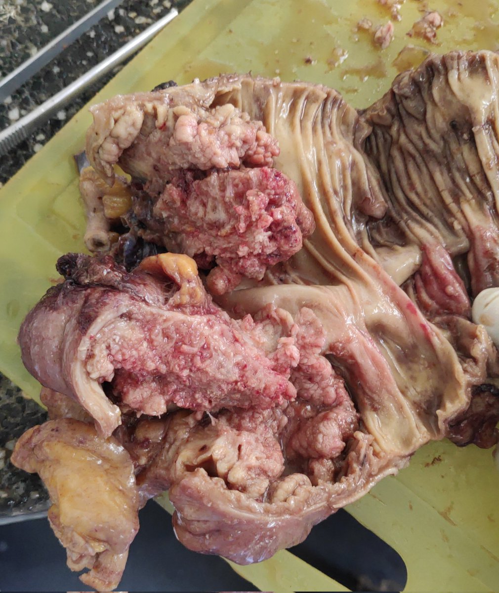 joemdoc's tweet image. Hey #twitterPath, do you guys see such big tumors 👇 👇