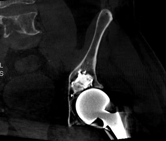 Jemianne Bautista Jia, MD (@jemir_md) on Twitter photo Multiple myeloma and lytic peri-acetabular lesion. My first osteoplasty, thank you <a href="/SeanTutton/">Sean Tutton</a>! #IRad #WomeninIR Multiple myeloma and lytic peri-acetabular lesion. My first osteoplasty, thank you <a href="/SeanTutton/">Sean Tutton</a>! #IRad #WomeninIR