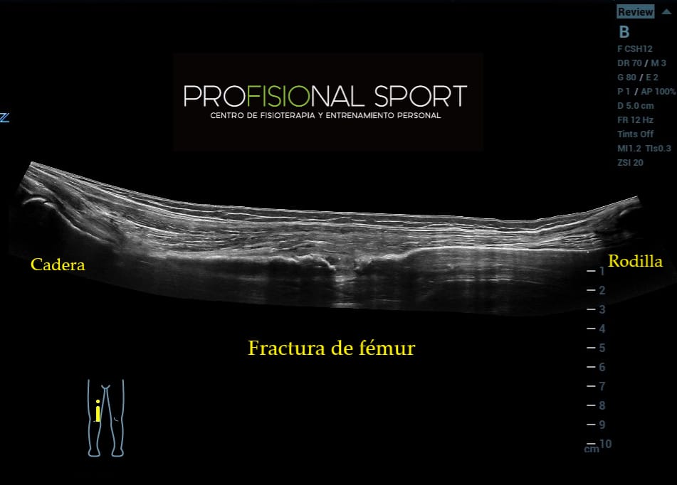 #Ecografía de una #factura de #fémur, en niña de 10 años, tras #caída de #caballo.

Tras meses de #trabajo y #recuperación, nos alegramos de poder decir que la #paciente está totalmente recuperada.

profisionalsport.com 

#Fisioterapia #Readaptación #ProfisionalSport #Boadilla