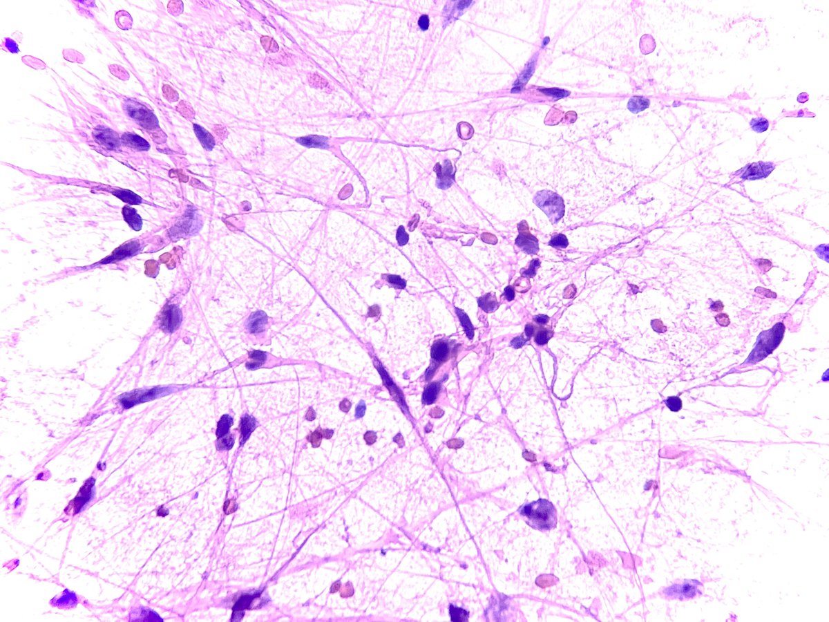 solcosao's tweet photo. 9yo 👧🏾 with chiasmatic tumor. 

🧬60% of all cases harbour the KIAA1549::BRAF fusion.

〰️pyloid cells and fibrillary background.

2021 WHO Classification of Tumours included this entity in the “circumscribed astrocytic gliomas” group.

PILOCYTIC ASTROCYTOMA https://t.co/OyYbMwPbfS