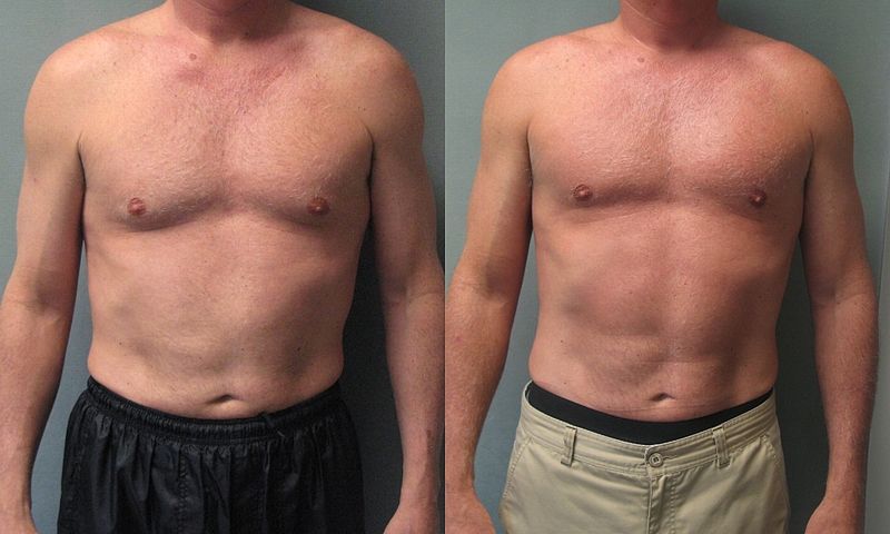 WantScience's tweet image. Gynecomastia vs. Chest Fat: What You Need to Know - wewantscience.com/news/gynecomas…