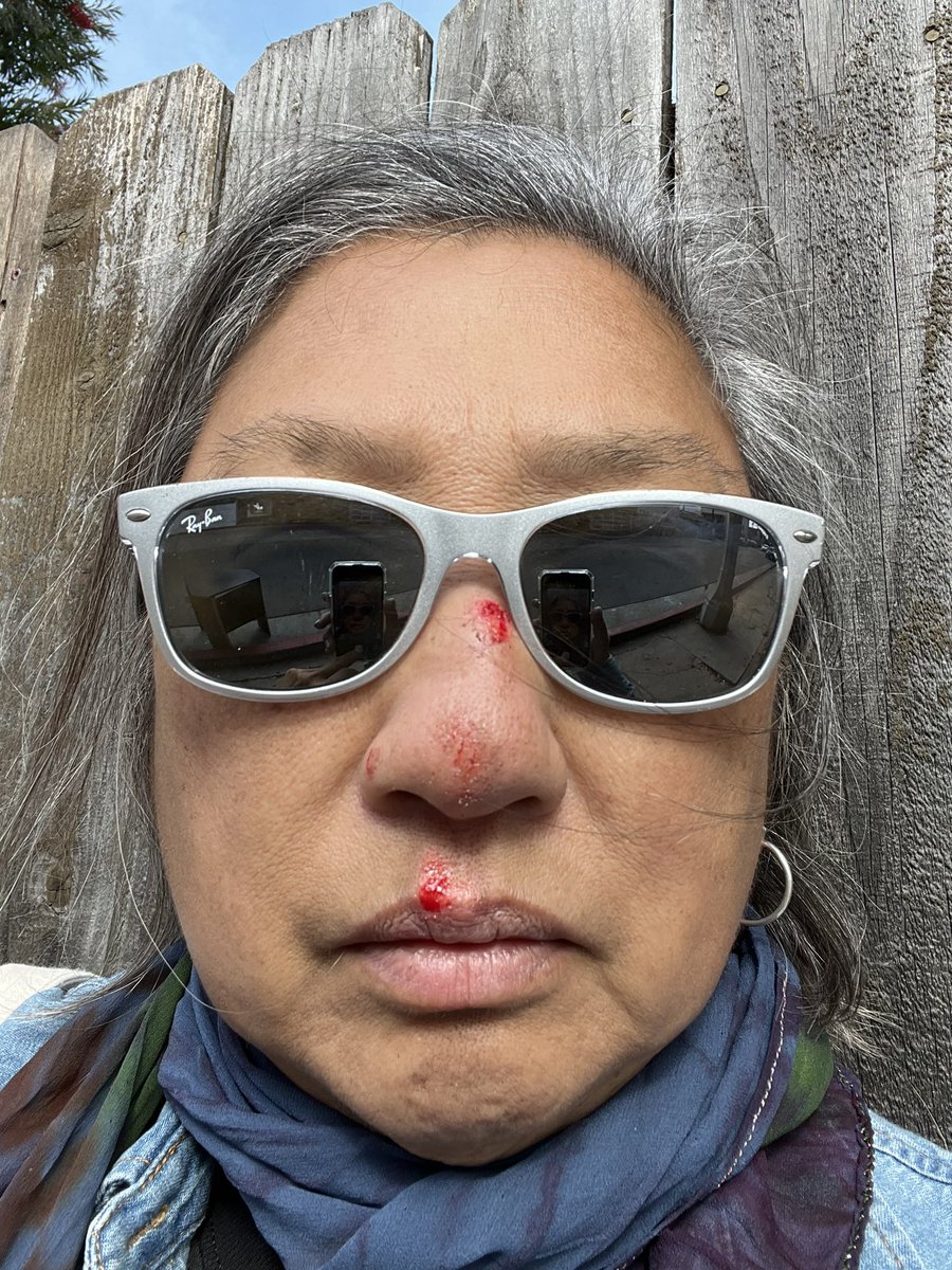 SBak007's tweet photo. Ouch I fell on my face. #SkinFix time. Ugh. https://t.co/hKQGVLlMna