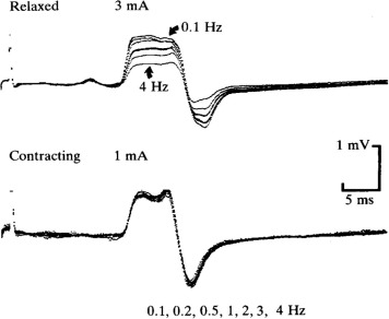ClinicalNeuroph's tweet photo. [Review of H reflexes] Burke: “H reflexes recorded at rest from muscles for which no reflex can normally be demonstrated is evidence of hyperreflexia, raising suspicion of ALS if there is denervation in that muscle.”

https://t.co/YkbPnvClRf
#ALS #Hreflex #ClinicalNeuroph https://t.co/MItrE4NHAS