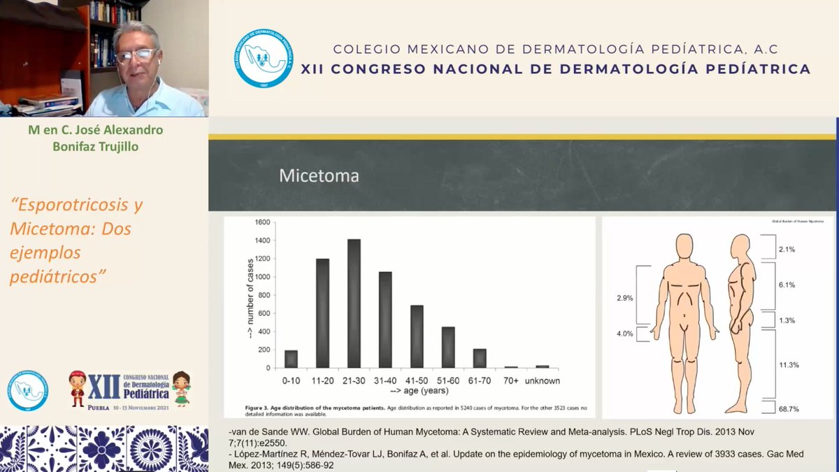 colmexdermaped's tweet photo. Esporotricosis y Micetoma: Dos ejemplos pediátricos.
M en C. José Alexandro Bonifaz Trujillo -Los desafíos en  micetoma: diagnóstico oportuno y correcto, fármacos más baratos, evitar la cirugía, pruebas de sensibilidad in vitro.- #micología #dermatologia #dermatology #XIICNDP2021 https://t.co/fen9ecthOR