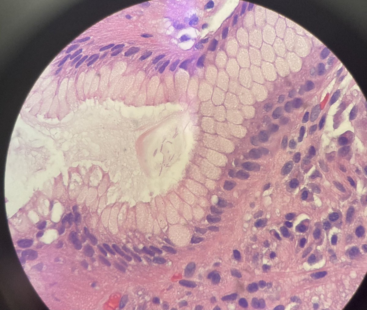 Eli Finkelsztein (@ejfinkel) on Twitter photo Zoom in to find Helicobacter heilmannii 🧬 🌪 on gastric mucosa. Zoonotic. Easier to see its twists vs H pylori. Once again, thank you Micro and Path. <a href="/WCM_ID/">Weill Cornell Infectious Diseases Division</a> <a href="/WCMCPathology/">Weill Cornell Medicine Pathology</a> #WCMCMicroLab #IDTwitter Zoom in to find Helicobacter heilmannii 🧬 🌪 on gastric mucosa. Zoonotic. Easier to see its twists vs H pylori. Once again, thank you Micro and Path. <a href="/WCM_ID/">Weill Cornell Infectious Diseases Division</a> <a href="/WCMCPathology/">Weill Cornell Medicine Pathology</a> #WCMCMicroLab #IDTwitter