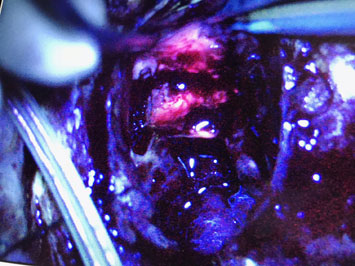 MedexusInc's tweet photo. Imaging agent #Gleolan has marked a landmark in the fight against brain cancers, making it easier to locate tumor cells during removal. For two Halifax neurosurgeons,  the advancement is "exciting."

Read their story on @CBCNews here: https://t.co/6HwtY4iy4D https://t.co/N2juhUQHA2
