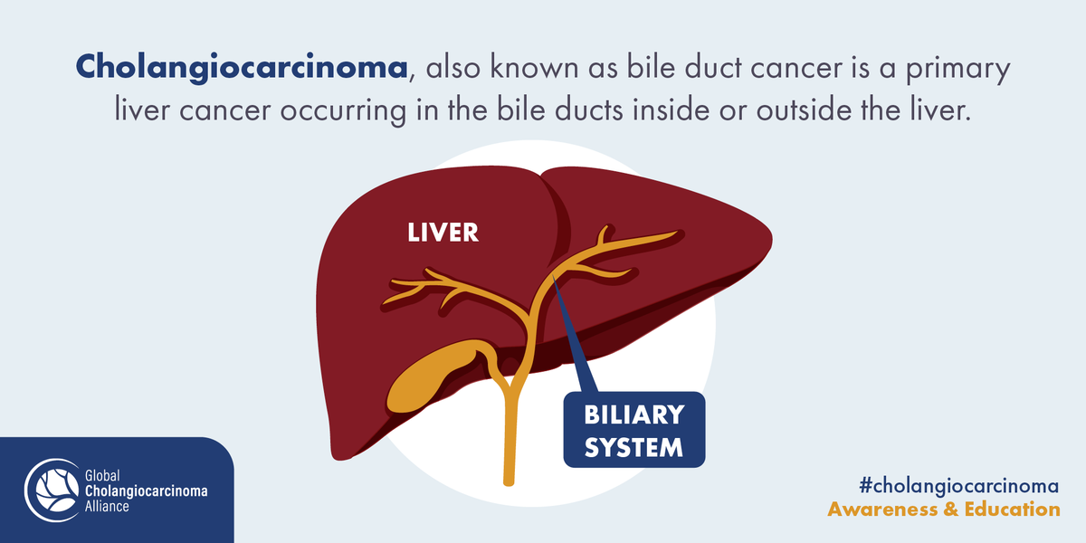 CCA_Alliance's tweet photo. DID YOU KNOW THAT: #Cholangiocarcinoma, also known as bile duct cancer, is a rare cancer that occurs in the bile ducts within, or outside, the liver. It is the second most common primary liver #cancer in the world and is one of the bilary tract cancers. https://t.co/U2bBB3y8l7