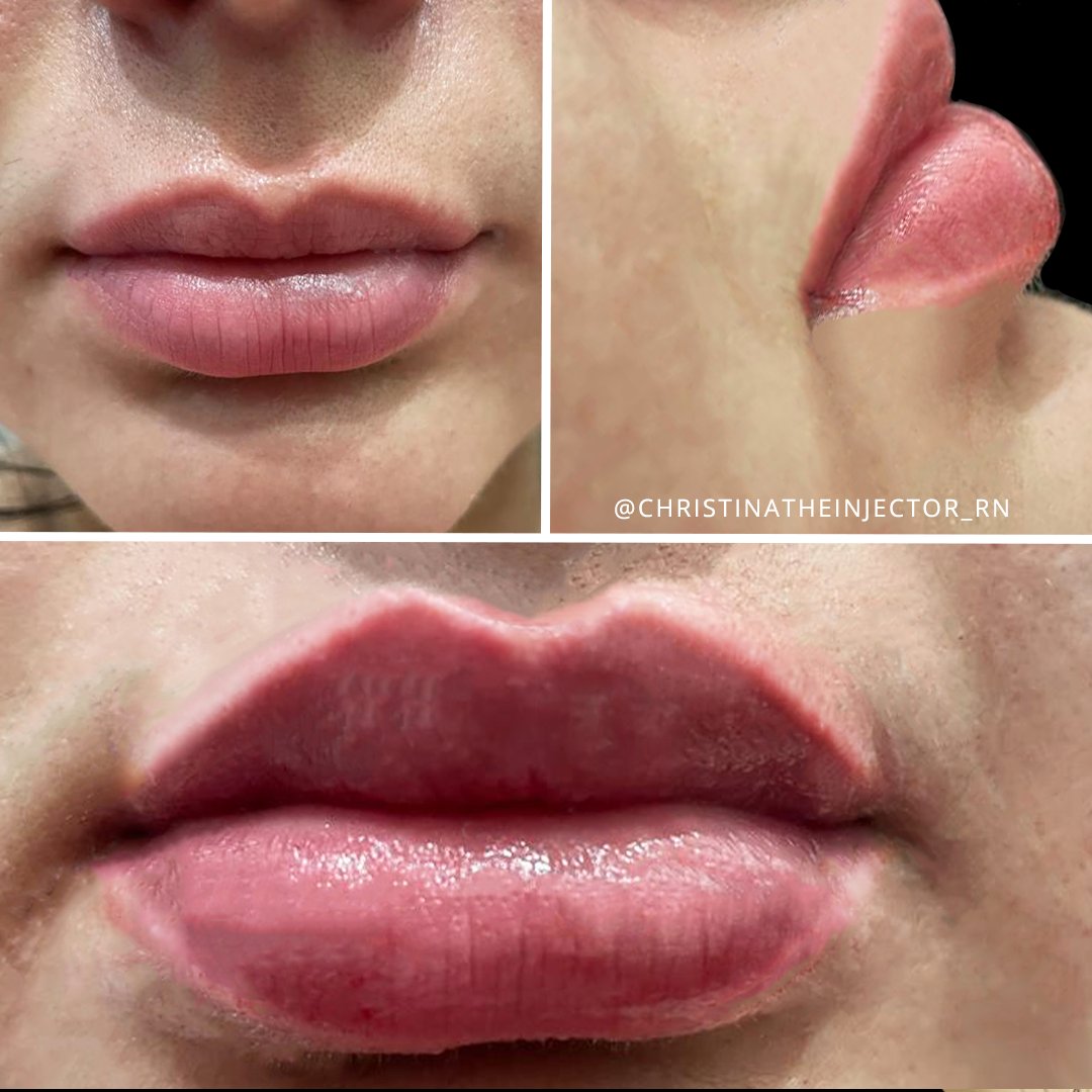 GeminiPlastics's tweet photo. #LipFillers #009
She loves her smooth #beautiful plump #lips...
Book Christina, RN Thurs & Sat!
https://t.co/lIbwlouYHD
Christina Macias, RN · Aesthetic Registered Nurse & #MasterInjector
Gemini #PlasticSurgery Aesthetic & Laser Center · #MedSpa
#RanchoCucamonga
909-463-0715 https://t.co/P832NTwfOm