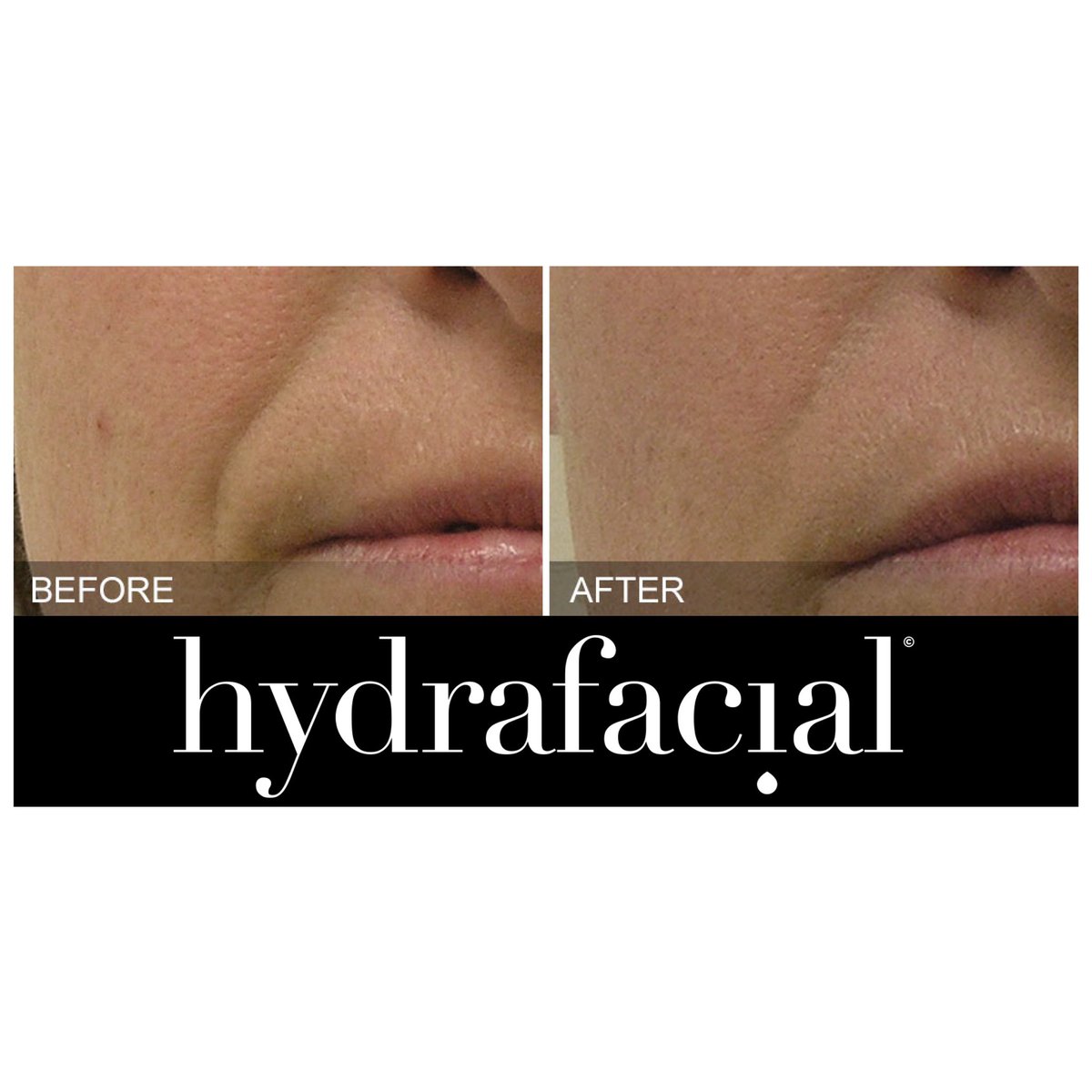 Check out this months Special Offer! 
Hydrafacial for ONLY €125
thebuffdayspa.com/special-offers/
#hydrafacial #thebuffdayspa 
T&amp;C’s apply