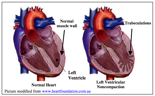 PatPath21's tweet photo. 🎯 LV noncompaction
- no compacted transformation of trabeculations
- mostly occur at the apex
- clinical manifestation: shortness of breath, dizziness, palpitations, and syncope
- may associate with hypertrophic CDM, histiocytoid CDM
@KMirza #twitterhomework #PathGrandRounds https://t.co/SHgE1sOe8Q