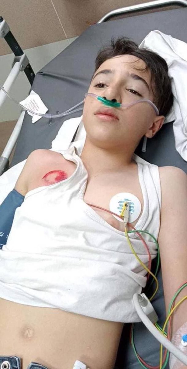 إصابة طفل من بلدة بدو شمال غرب القدس برصاصة مطاطية بالصدر أطلقتها قوات الاحتـلال خلال المواجهات التي اندلعت في منطقة الكرم، اليوم.