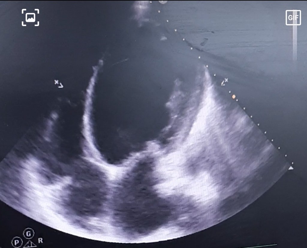 AElGOHARY87's tweet photo. One of the largest LV dimension I see before ..
LV EDD :8.4cm .
Case of ICM
What's your largest size LV?
#echofirst #CardioTwitter #echocard #Cardiology https://t.co/dZayvc5iWk