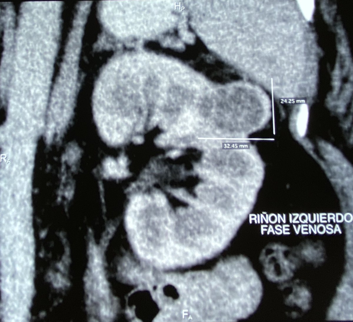 urovictore's tweet photo. CÁNCER DE RIÑÓN LOCALIZADO
Mujer de 49 años de edad.
Tumor renal izquierdo órgano-confinado,  pT1a.
Cirugía preservadora de nefronas por Laparoscopia en 2019.
Adecuado control oncológico y función renal preservada. https://t.co/OFcpQrVCC2