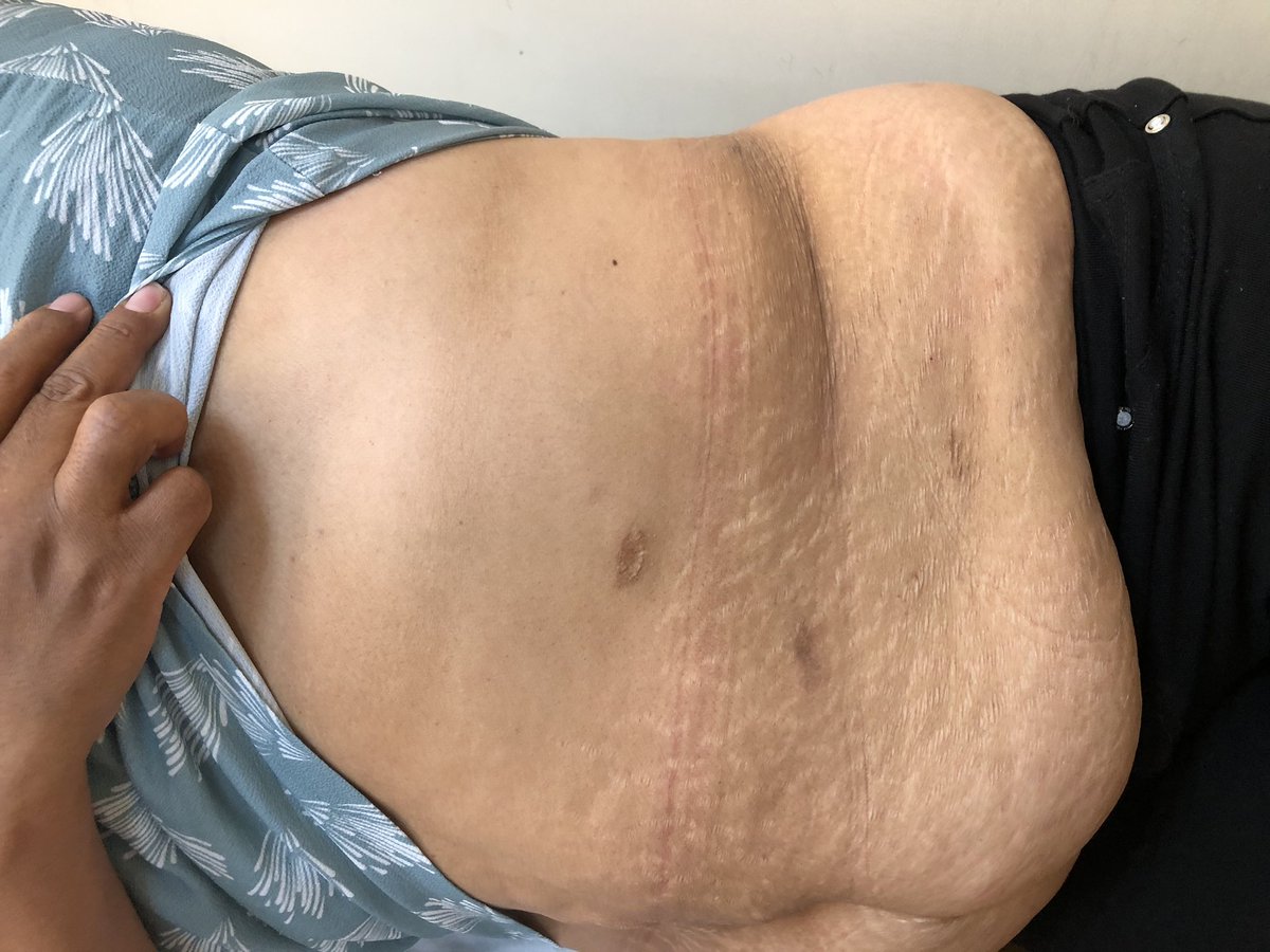 urovictore's tweet photo. CÁNCER DE RIÑÓN LOCALIZADO
Mujer de 49 años de edad.
Tumor renal izquierdo órgano-confinado,  pT1a.
Cirugía preservadora de nefronas por Laparoscopia en 2019.
Adecuado control oncológico y función renal preservada. https://t.co/OFcpQrVCC2
