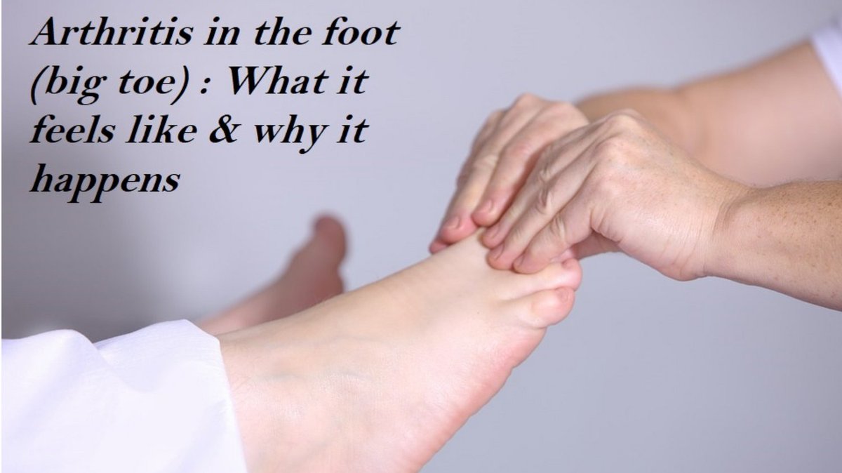 osteosynhealth's tweet photo. #arthritis in the big toe isn't the most common form, but it does happen sometimes. If you've ever been curious how and why, this video https://t.co/1e5PMyIPkn is an amazing resource! #jointhealth #toearthritis #jointpain #osteoarthritis #arthritissucks https://t.co/R8HXvSzklv