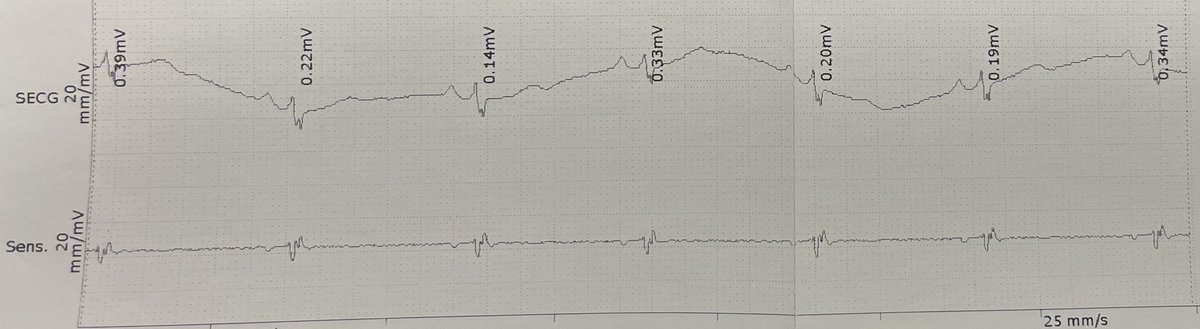 drgregharris's tweet photo. Patient with recent Robotic bypass surgery and a scar where I would normally place the ILR. Decided to go to the right of the sternum and DAMN those P waves. ⁦@BIOTRONIK_US⁩ #PWavesForTheDiagnosis https://t.co/ldM9KdKb2r