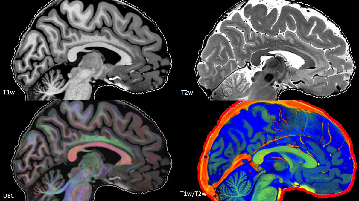 HumanBrainAtlas's tweet image. Cuts down the middle of the brain in our Human Brain Atlas. The four colourful contrasts permit us to properly maps its regions and connections. @neuraustralia #brain #brainmaps #brainscience #science #maps #beautifulbrain @uow @uowresearch @MarkusBarth2 @neuraimaging