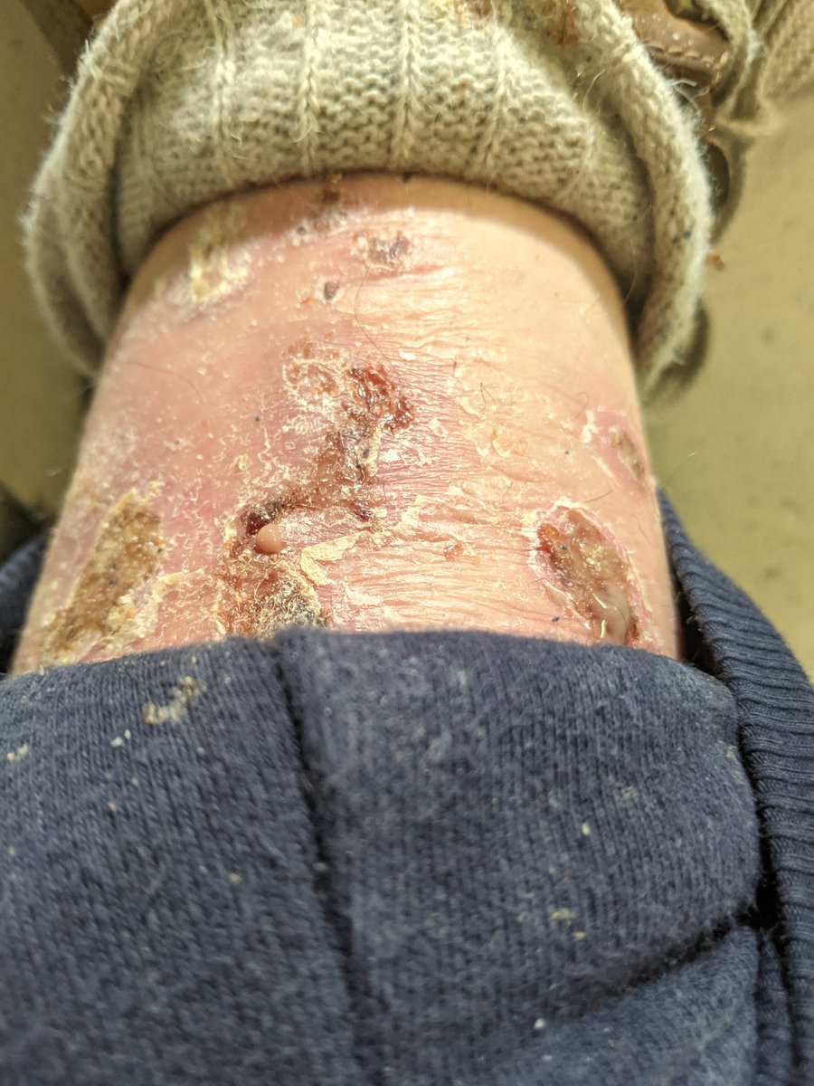 AHSMALPRACTICE1's tweet photo. Electrical conduction burns.
Floor has Electrical charge pulses from my cell phone.
Law enforcement trace the electronic sequence in transmission tags to catch criminals
RICO Act or Patriot Act; include charge of torture.
@CDCgov @ODNIgov @FCC @FBI @RCMPAlberta @CRTCeng @Android https://t.co/LIIIQgNzLV