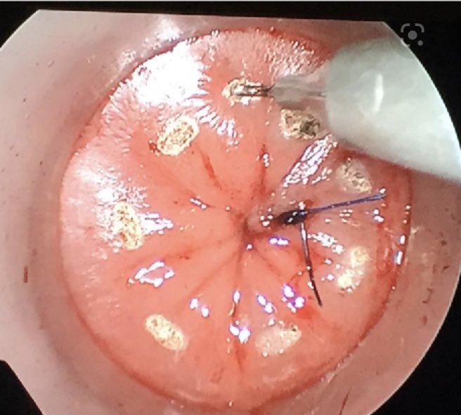 Techniques in Coloproctology Journal tweet media