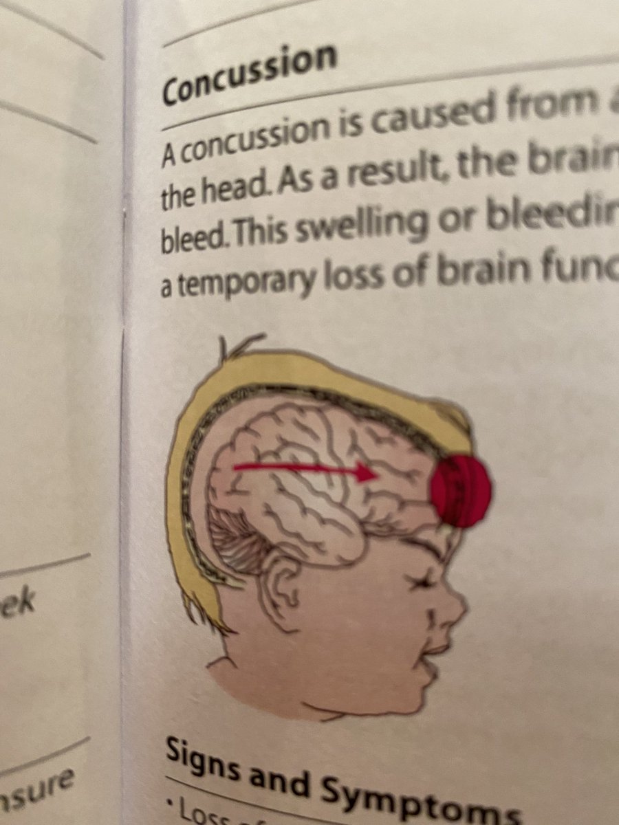 IanWeak's tweet image. A concussion is when your baby donald trump smashes his head into a rubber ball