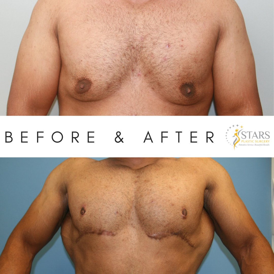 STARPlasticSurg's tweet photo. A #beforeandafter of a #gynecomastia patient. After is 3 months post-op and is feeling like a STAR! https://t.co/LnpRnFnonG