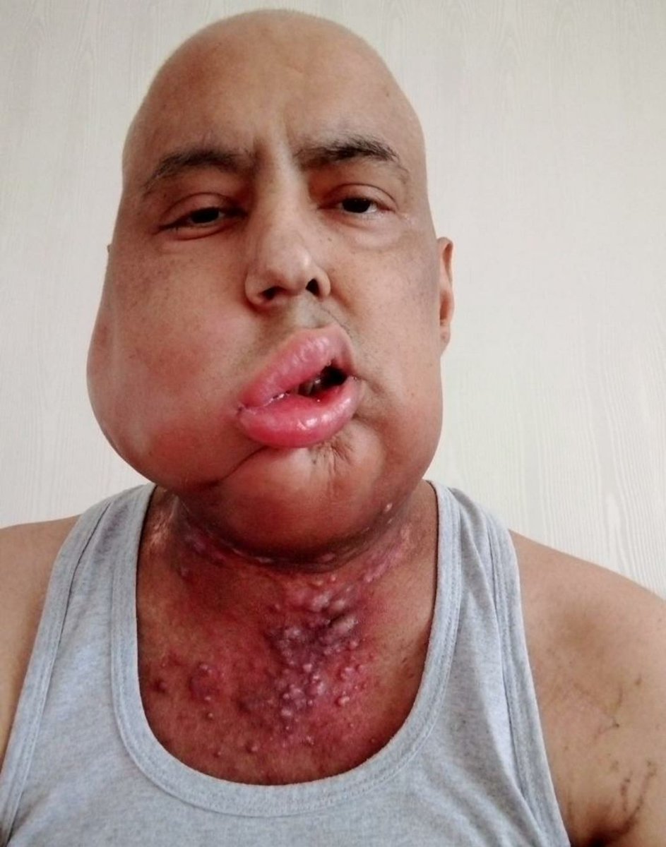 JournalistYaman's tweet photo. Adı İhsan Yıldız. İlkokul öğretmeniydi. 4. evre kanser hastası olmasına rağmen hapse attılar, zulmettiler. Vefat etti. Nasıl bir alçaklıktır!
Yine 4. evre kanser hastası olan Ayşe Özdoğan'ın da ölmesini bekliyorlar. O da hâla hapiste. Halsiz, bitkin, ölmeyi bekler hale gelmiş. https://t.co/TDBayvNthd