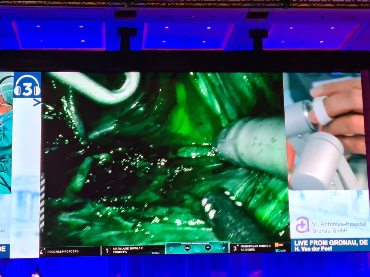 LambAlastair's tweet photo. Lovely ePLND w #ICG enhancement by @hvdpoel at #ERUS21. No doubt it optimises LN clearance (if LND even needed...) 

But likely focus of targeted #FluoroGuidedSurgery will be local margin clearance a la #NeuroSAFE. #PROMOTE_Study stage 2 starts Dec! Great to collaborate on this. https://t.co/1SiN0vVn5Q