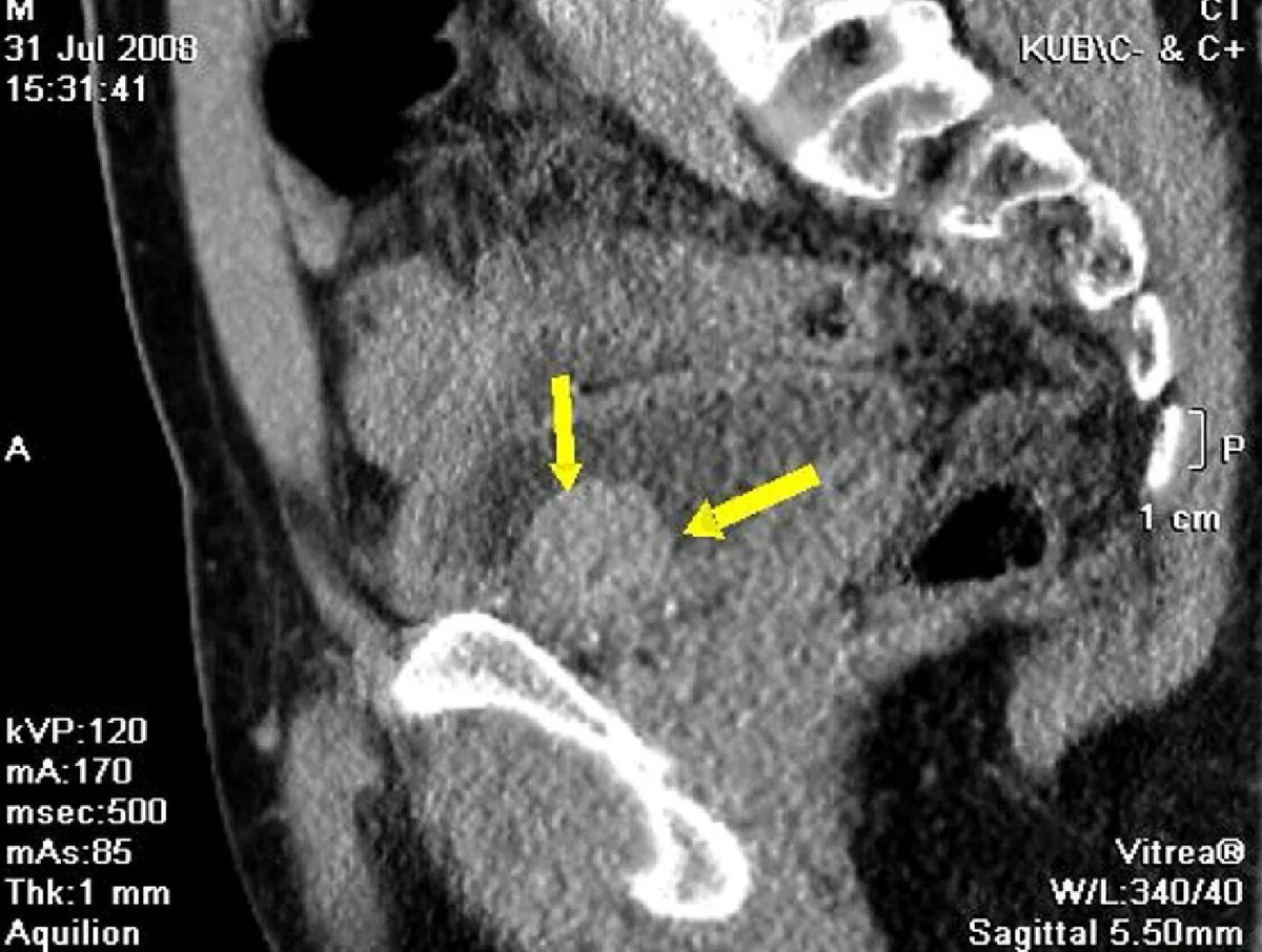 AJKDonline's tweet photo. 2011 #Quiz: A man with no known med conditions presented with concerns of severe headache, dizziness, palpitations every time he urinated for last 5 yrs. His discomfort while urinating had led him to avoid drinking water unless absolutely thirsty.

https://t.co/1Y67kTvj9K (FREE) https://t.co/K6HbpM4upB
