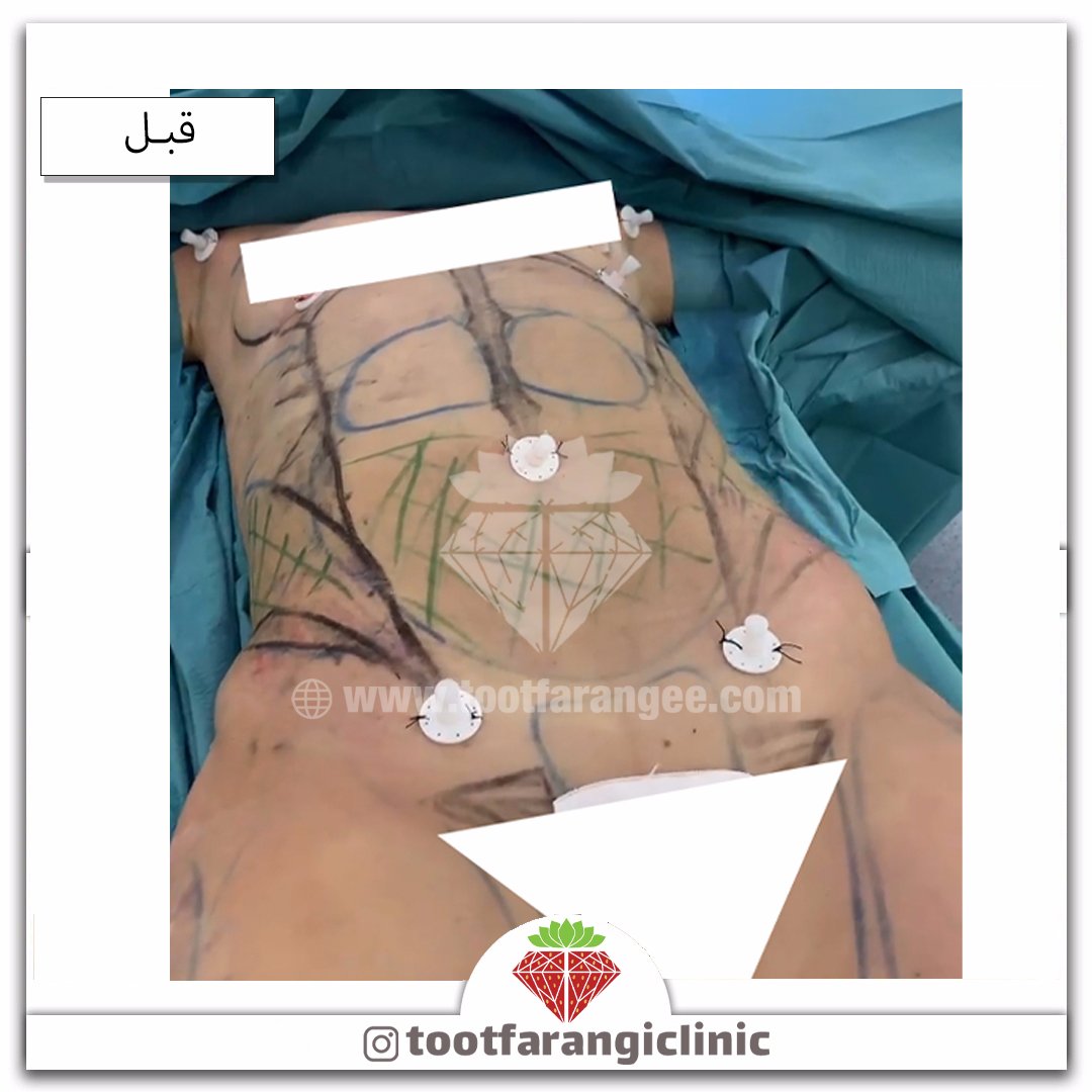 Tootclinic's tweet photo. #پیکرتراشی #ویزر #زیبایی #لیپوماتیک #لاغری #تناسب_اندام #رژیم https://t.co/RrBMDvdFLQ