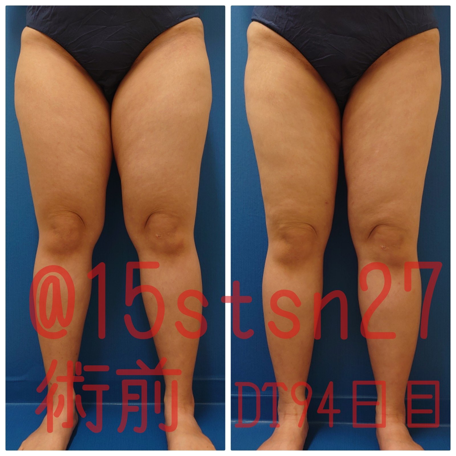 ごんちゃん 太腿臀部脂肪吸引dt中 15stsn27 Twitter
